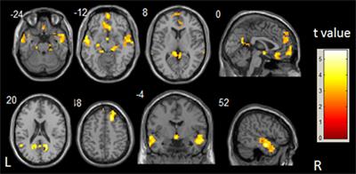 Altered Default Mode Network on Resting-State fMRI in Children with Infantile Spasms